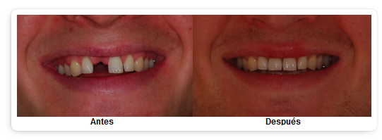 IMPLANTES DENTALES